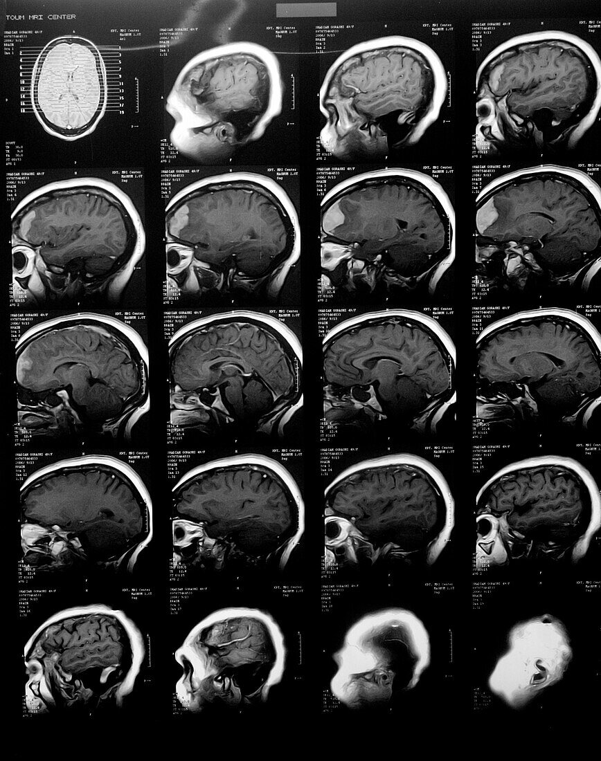 Bilateral papilledema, MRI scan