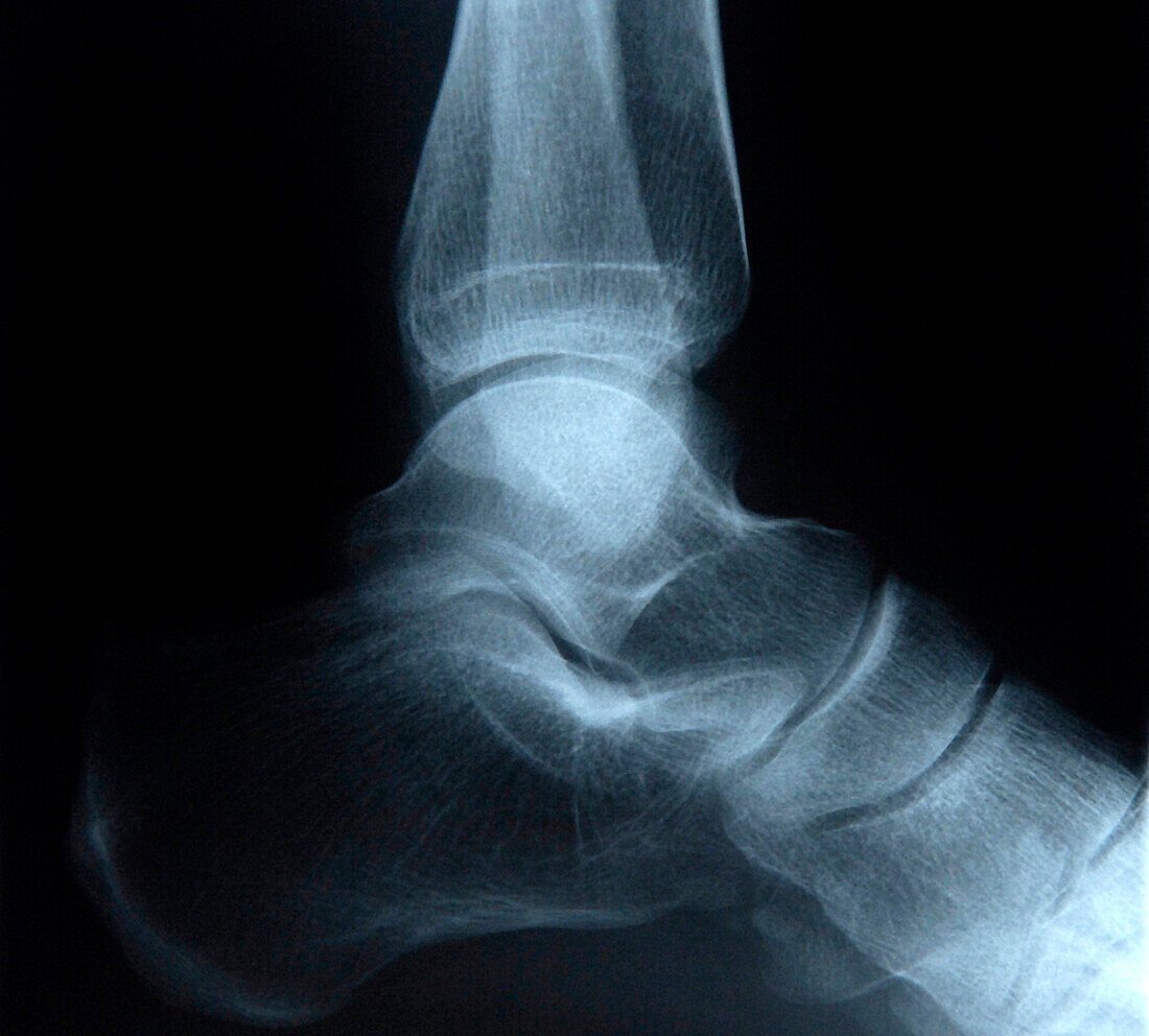 Ankle, X-ray