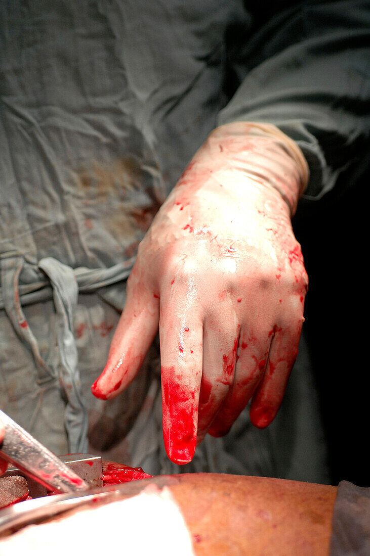 Blood-stained surgical glove