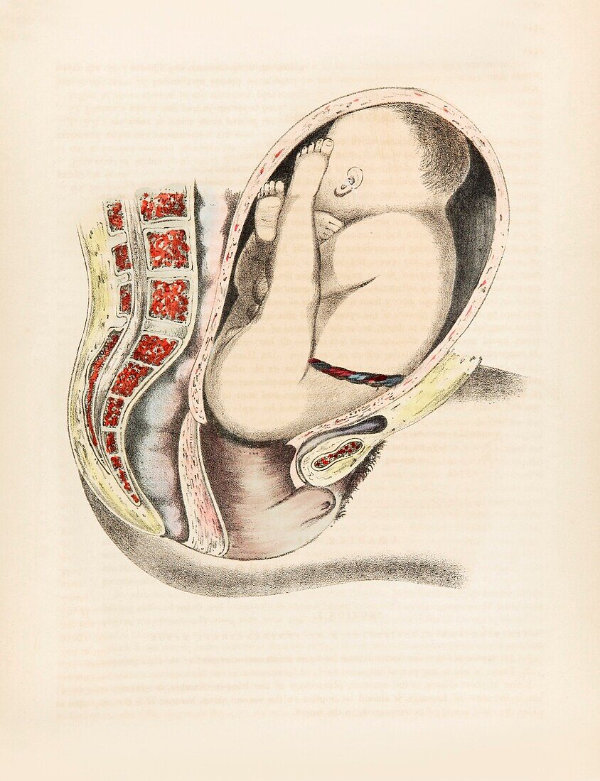 Foetus in breech position, 19th century illustration