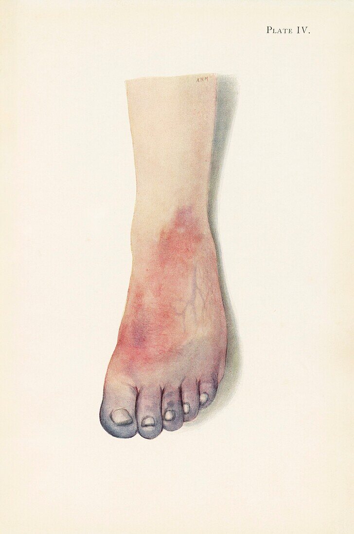 Gangrene of a foot from chlorine poisoning, illustration