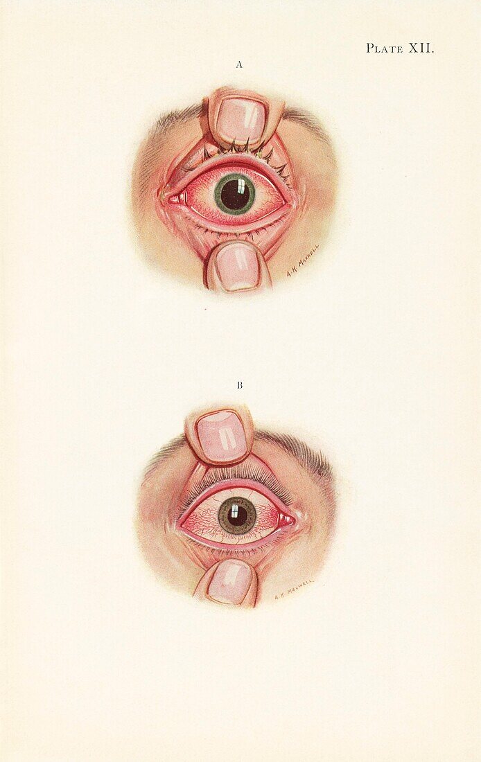 Severe burning of an eye from gas poisoning, illustration