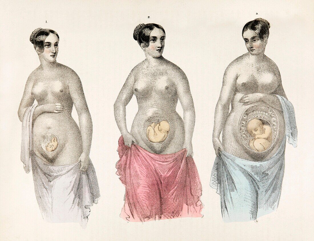 Stages of pregnancy, 19th century illustration