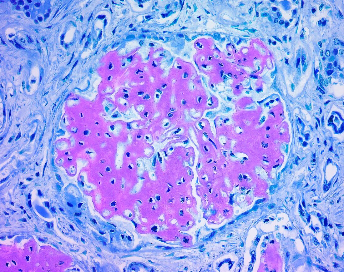 Renal Amyloidosis, LM