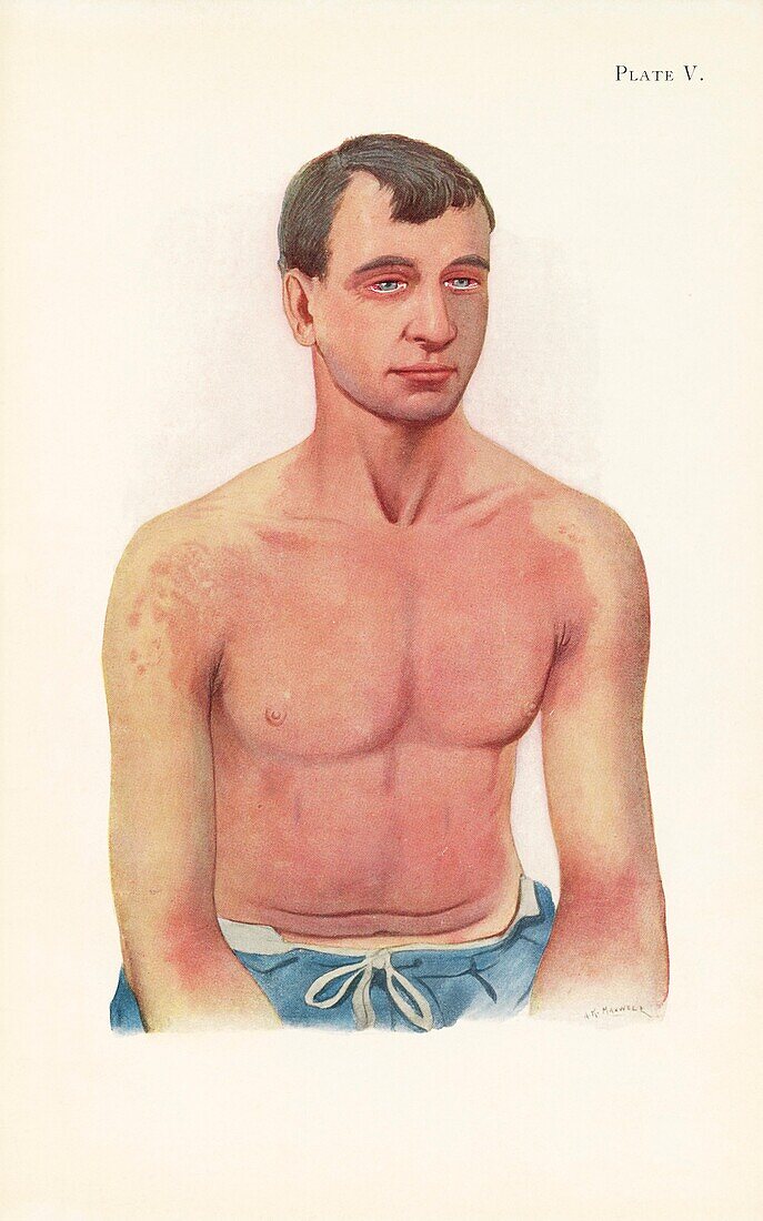 Erythema from mustard gas poisoning, illustration