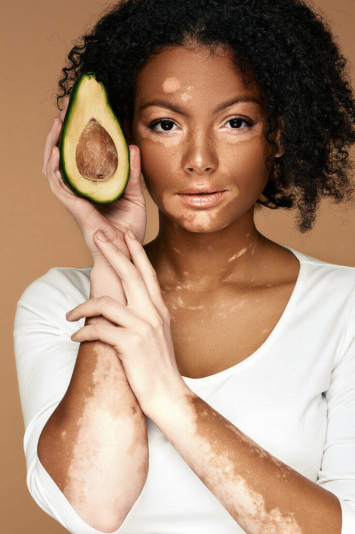 Woman with vitiligo