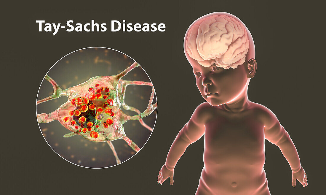 Tay-Sachs disease, computer illustration