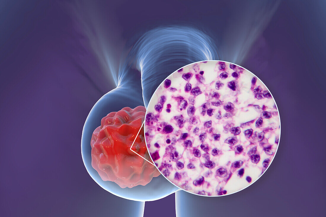 Testicular cancer, illustration and light micrograph