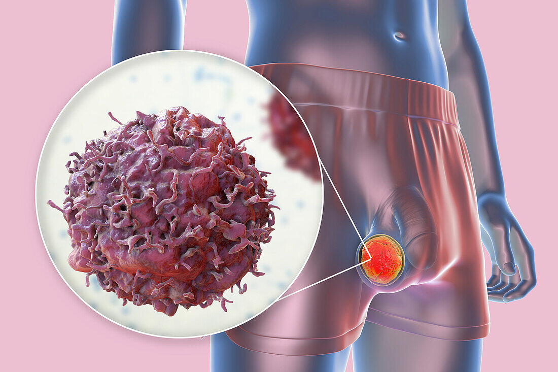 Testicular cancer, illustration