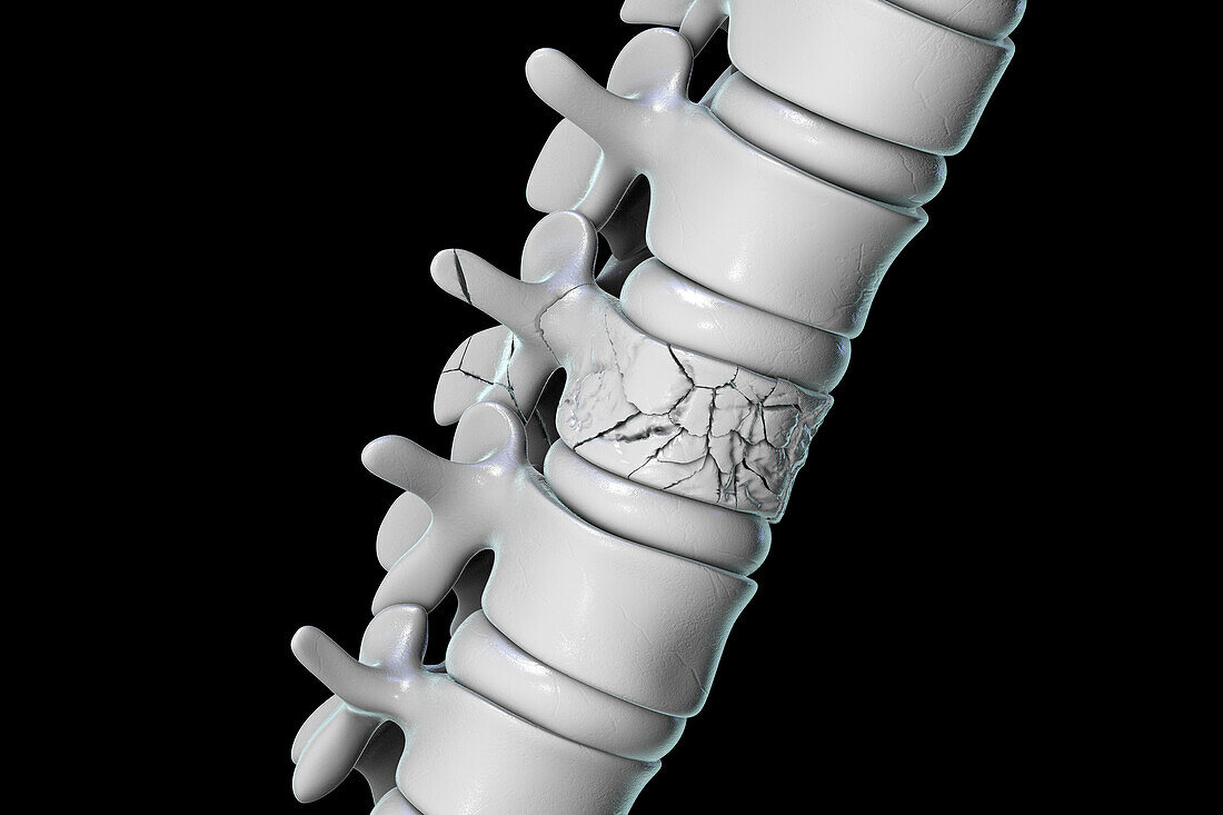 Spinal fracture, illustration