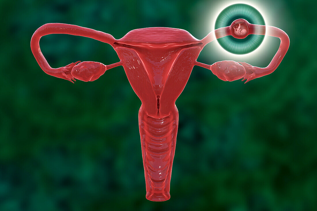 Ectopic pregnancy, illustration