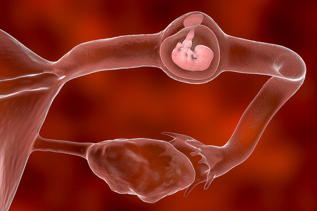 Ectopic pregnancy, illustration
