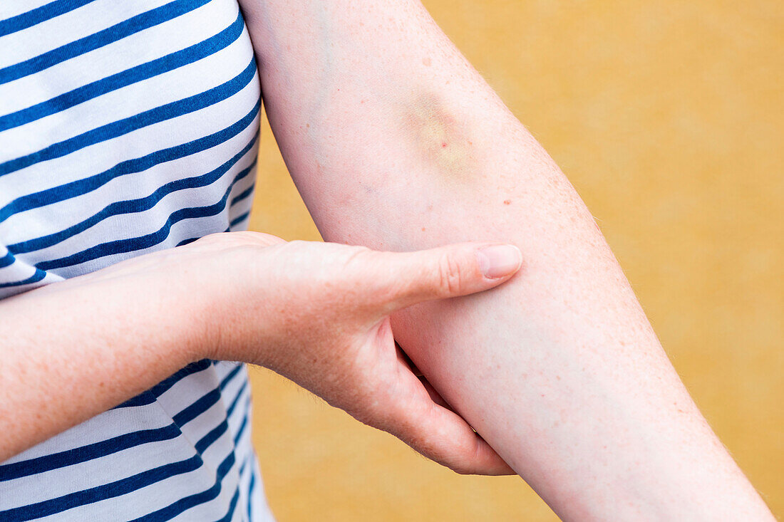 Bruise after blood sample