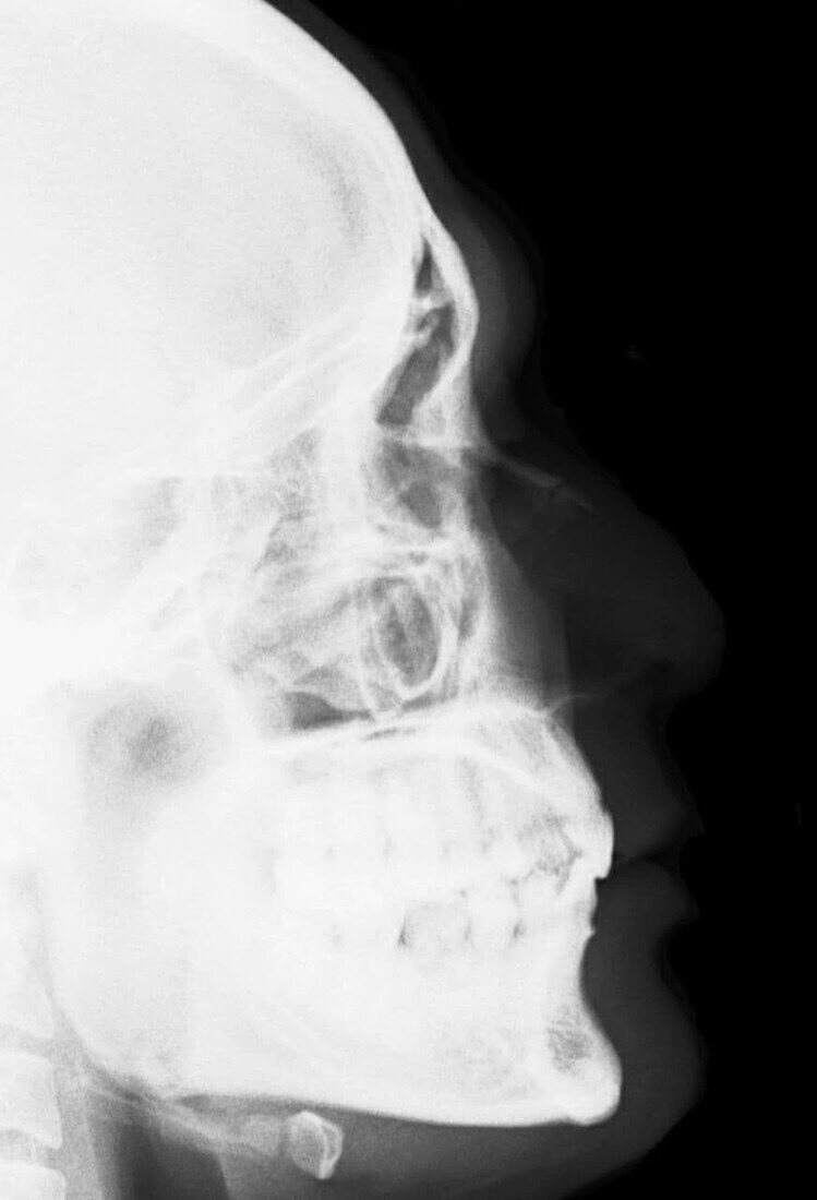 Fractured nose, X-ray