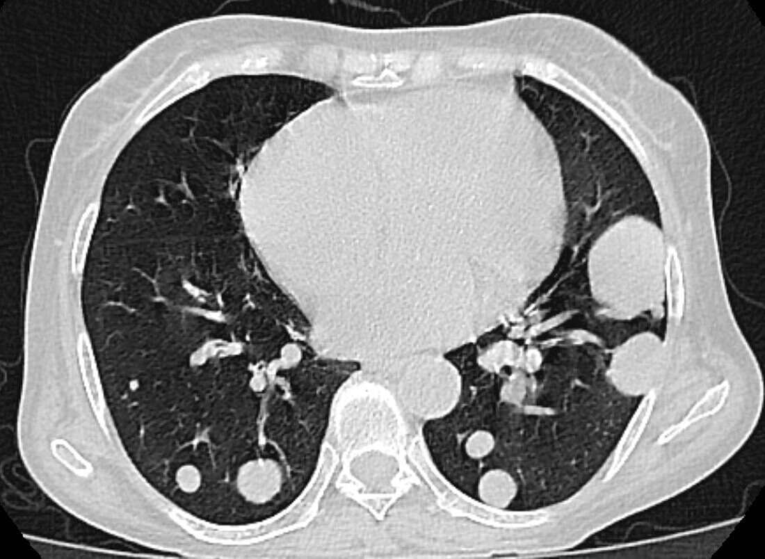 Cannonball pulmonary metastases, X-ray