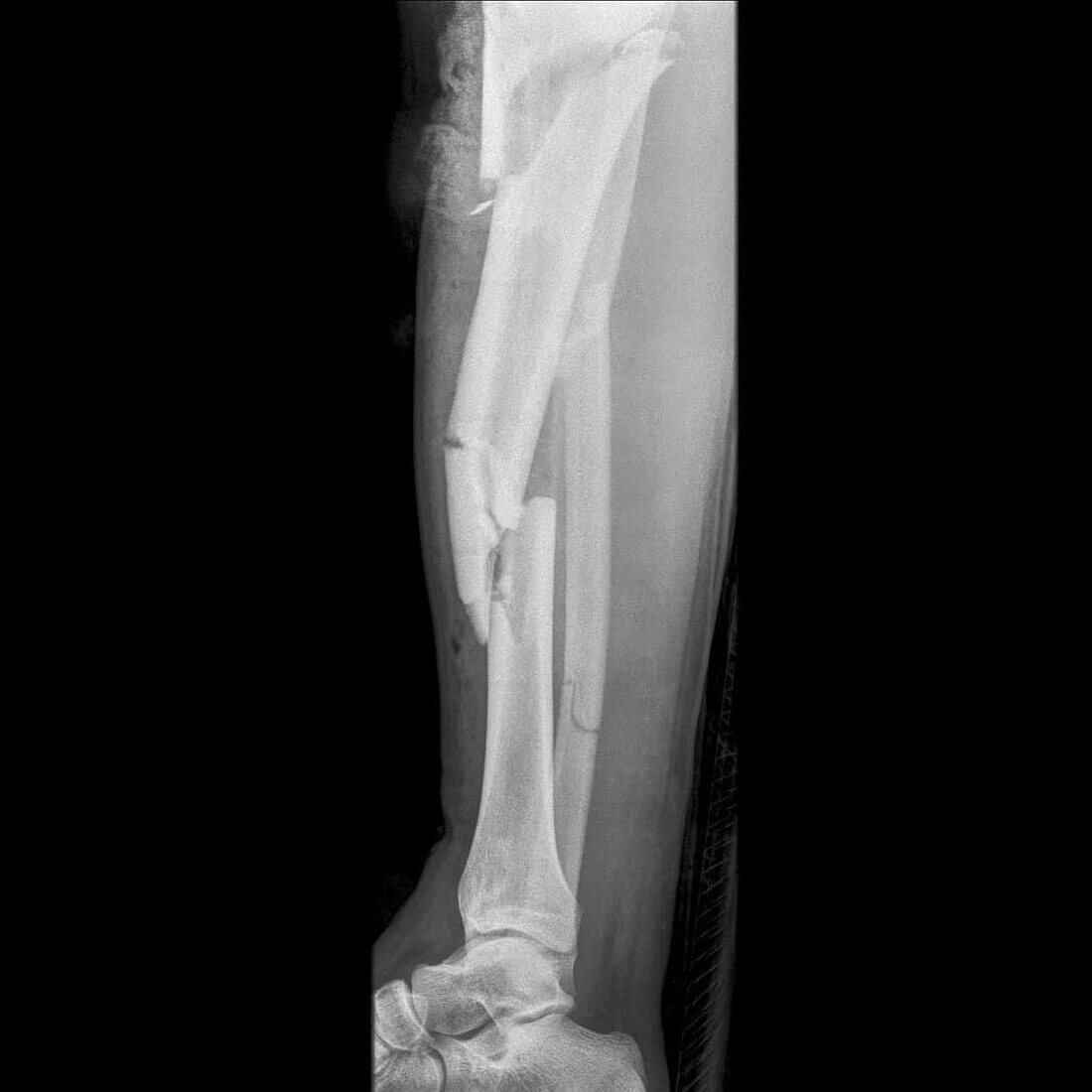 Fractured leg, X-ray