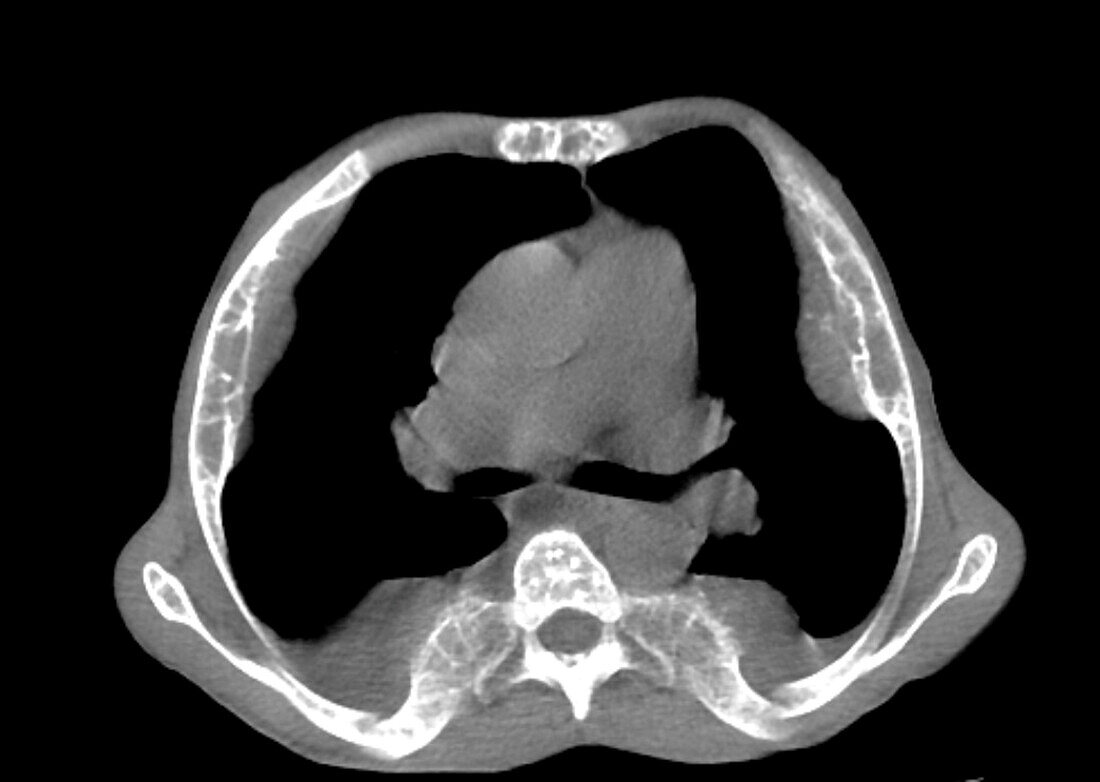 Extramedullary haematopoiesis, CT scan