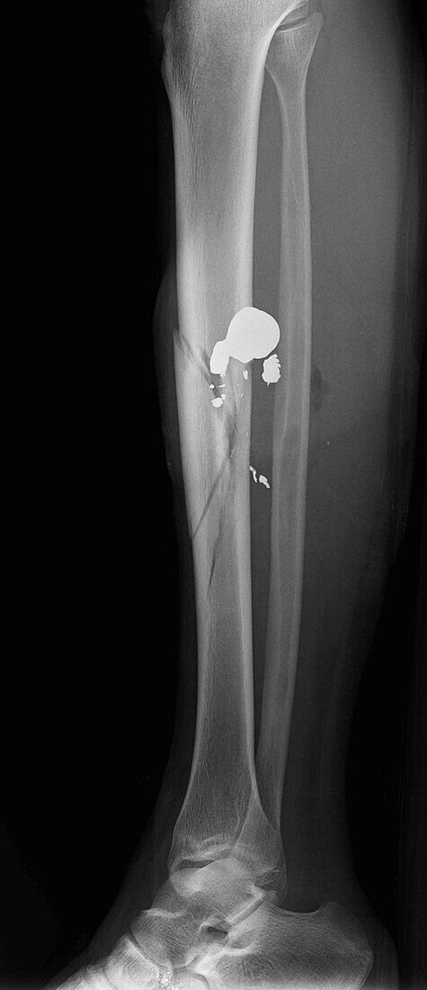 Gun shot in leg, X-ray