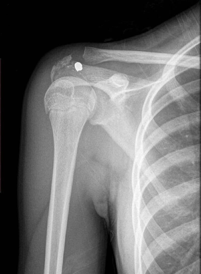 Gun shot in shoulder, X-ray