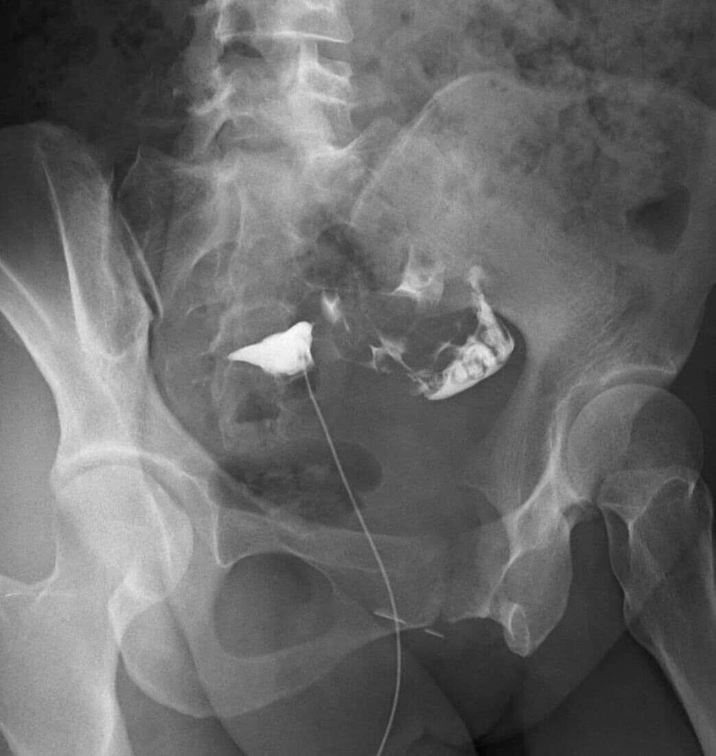 Blocked fallopian tube, X-ray