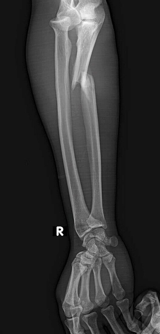 Monteggia fracture, X-ray