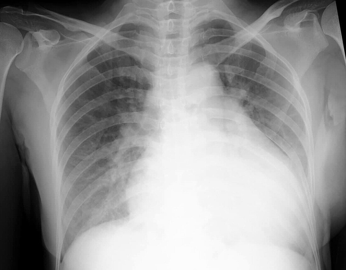 Enlarged heart and pulmonary oedema, X-ray