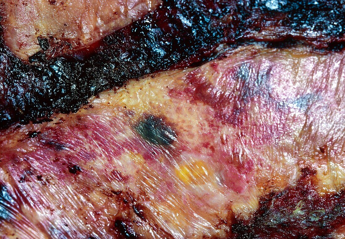 Burn injury covered with amnion as dressing