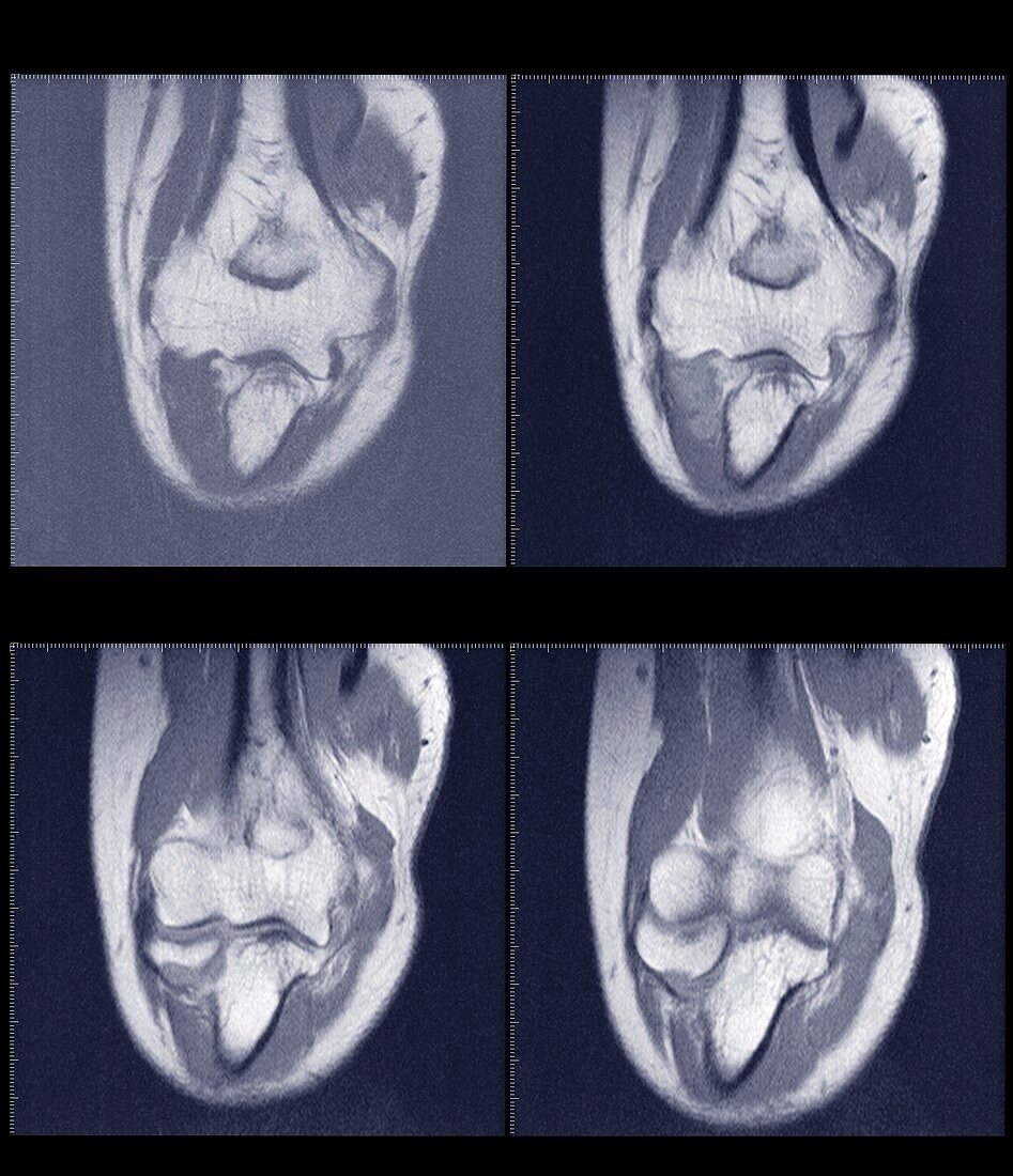 Ankle joint cross section, MRI