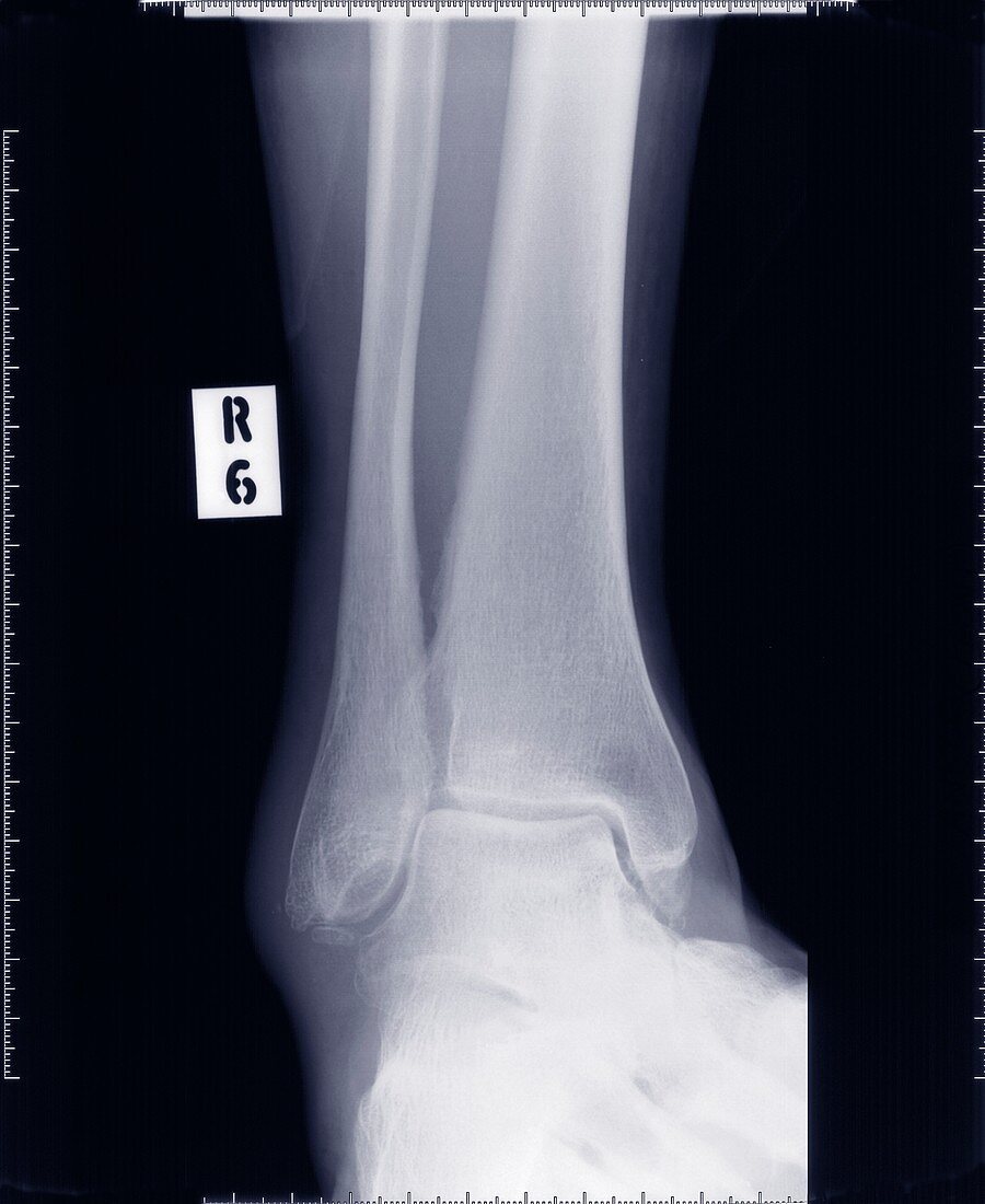 Ankle joint, X-ray