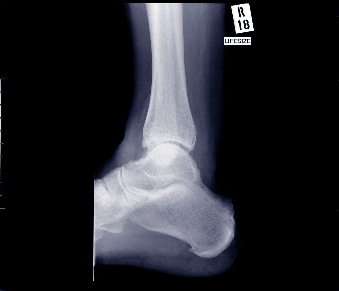 Ankle joint from side, X-ray
