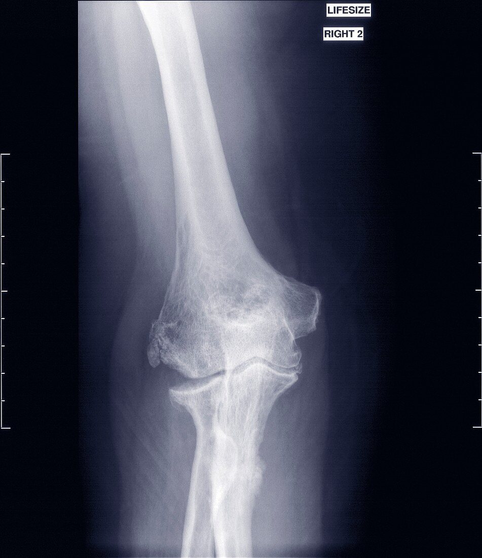 Elbow, X-ray