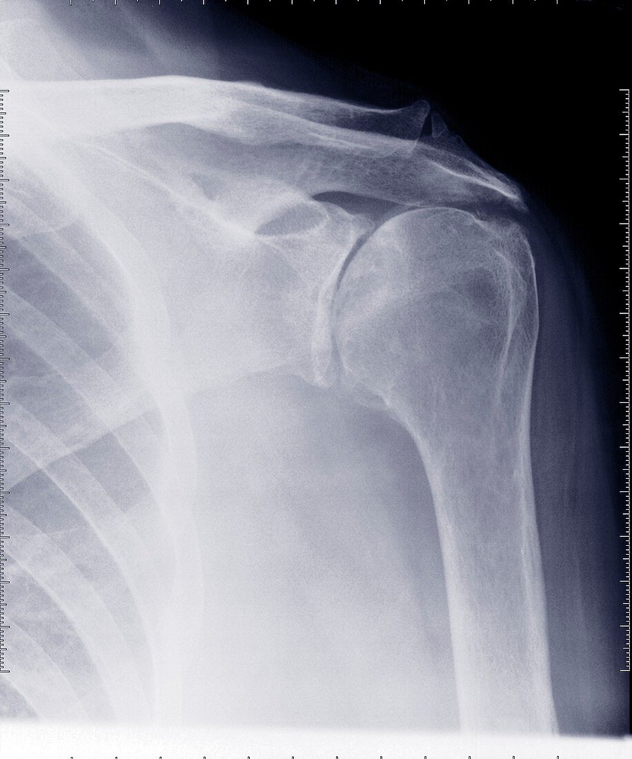 Shoulder ribs and clavicle, X-ray