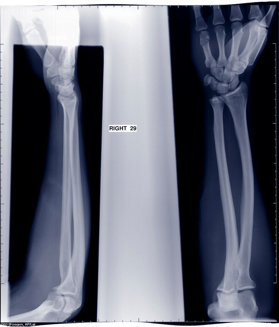 Films of two arms and wrists, X-ray