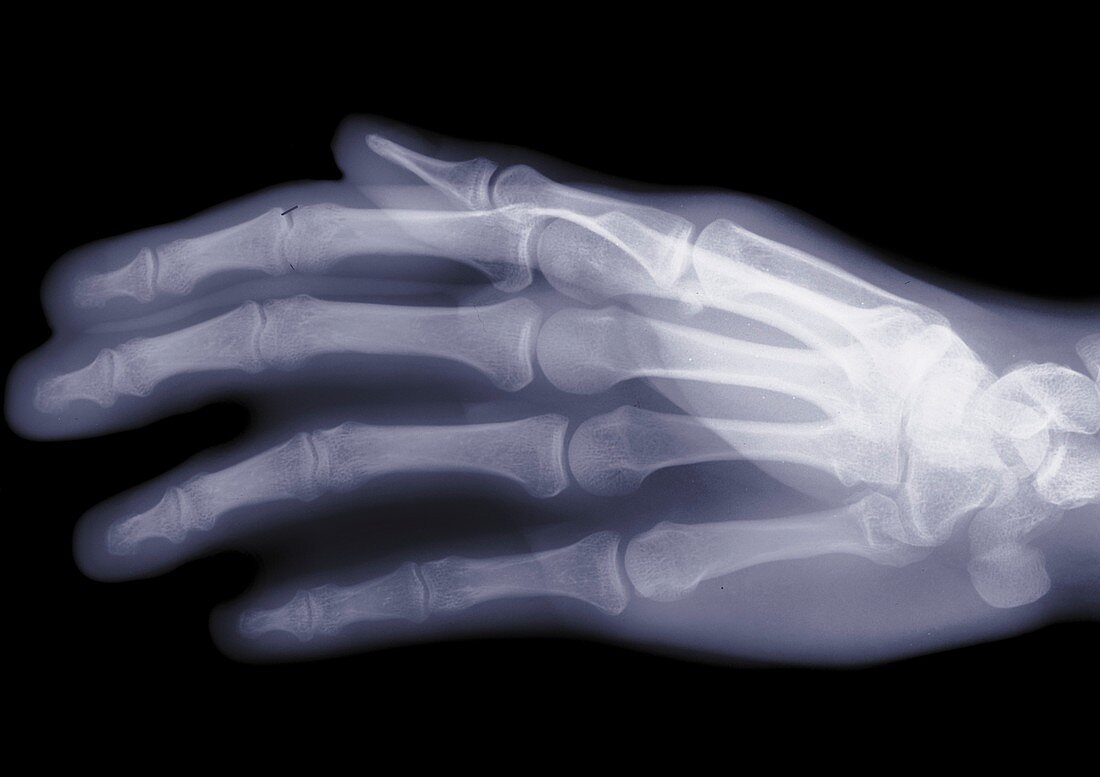 Human hand, X-ray