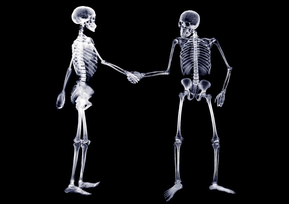 Two skeletons shaking hands, X-ray