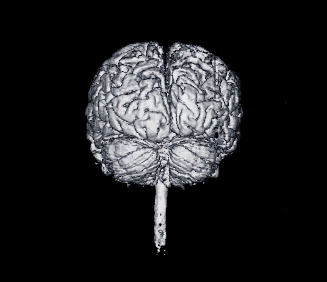 Front view of brain, X-ray