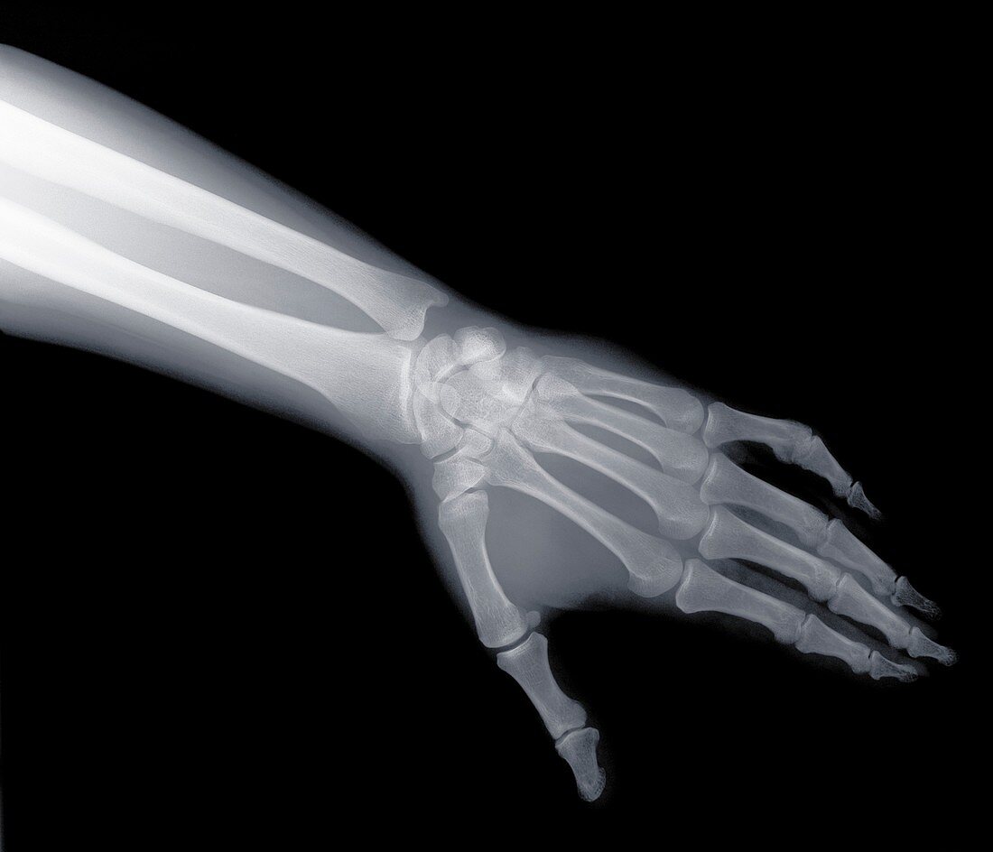 Arm and hand, X-ray