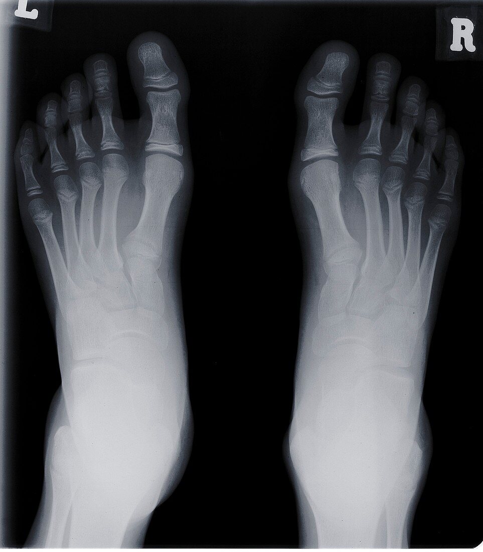 Human feet, X-ray