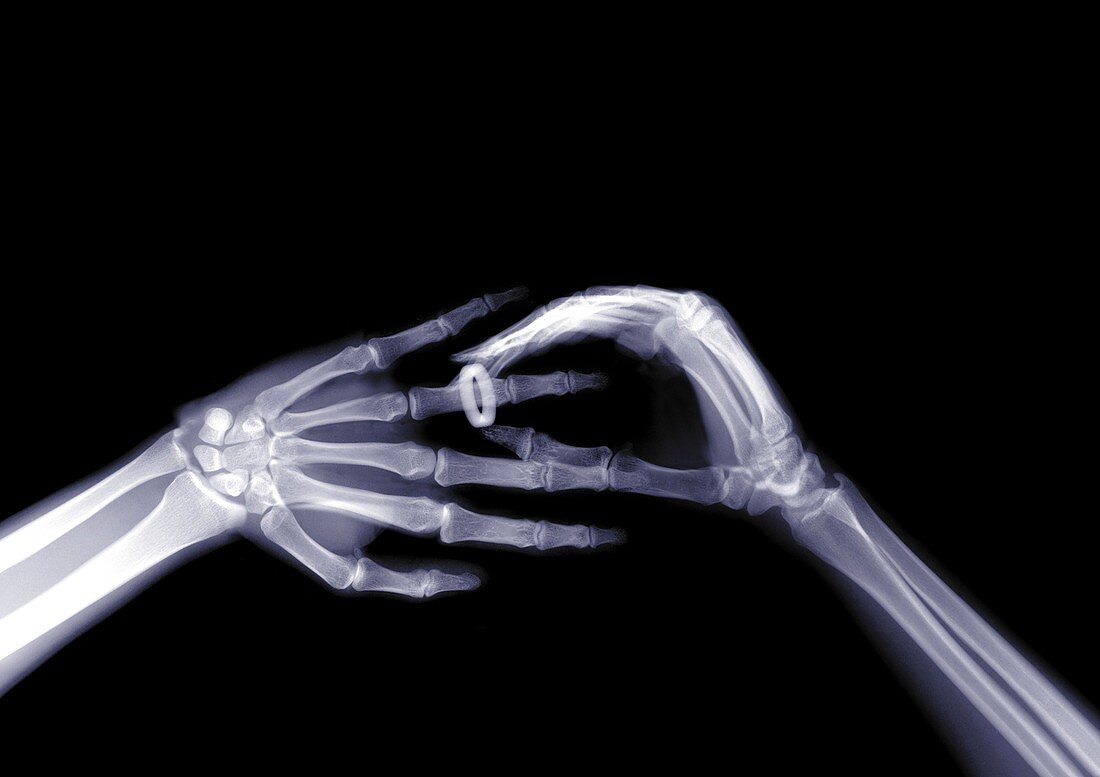 Wedding ring being placed on person's finger, X-ray