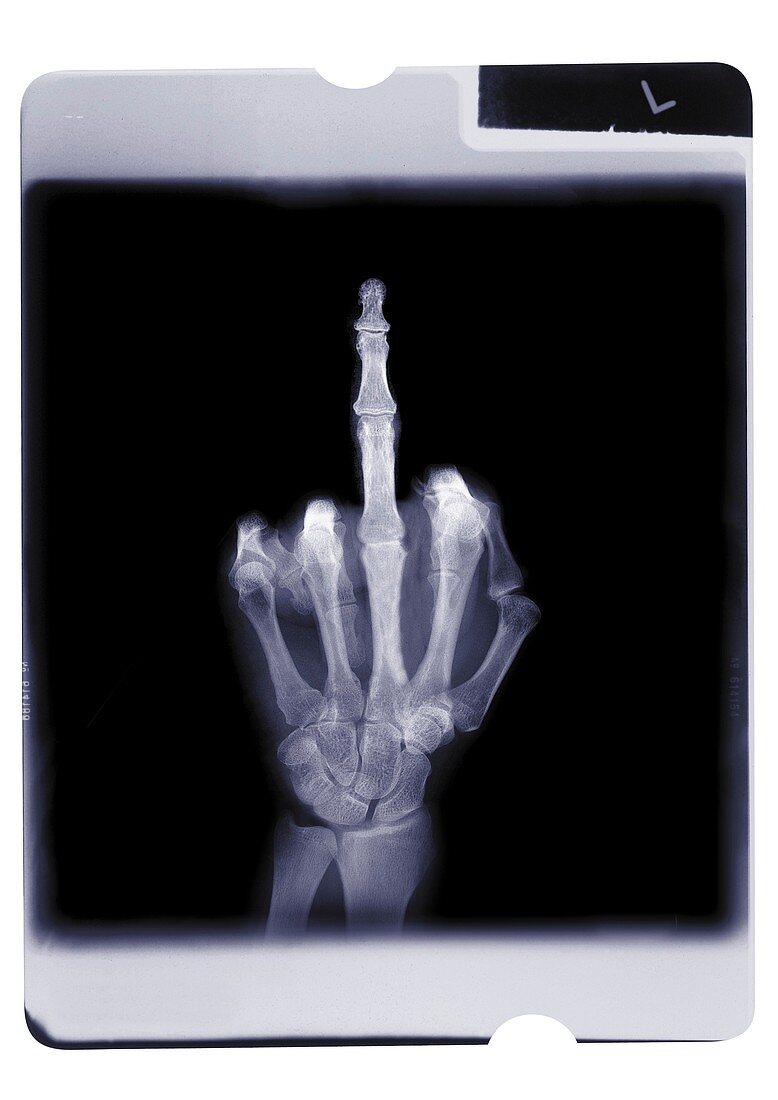 Hand with middle finger raised, X-ray