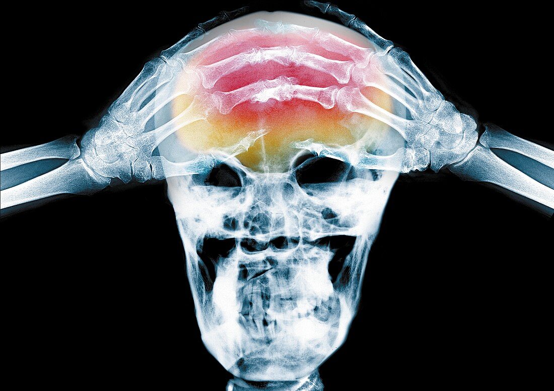 Person with hands on their head, X-ray