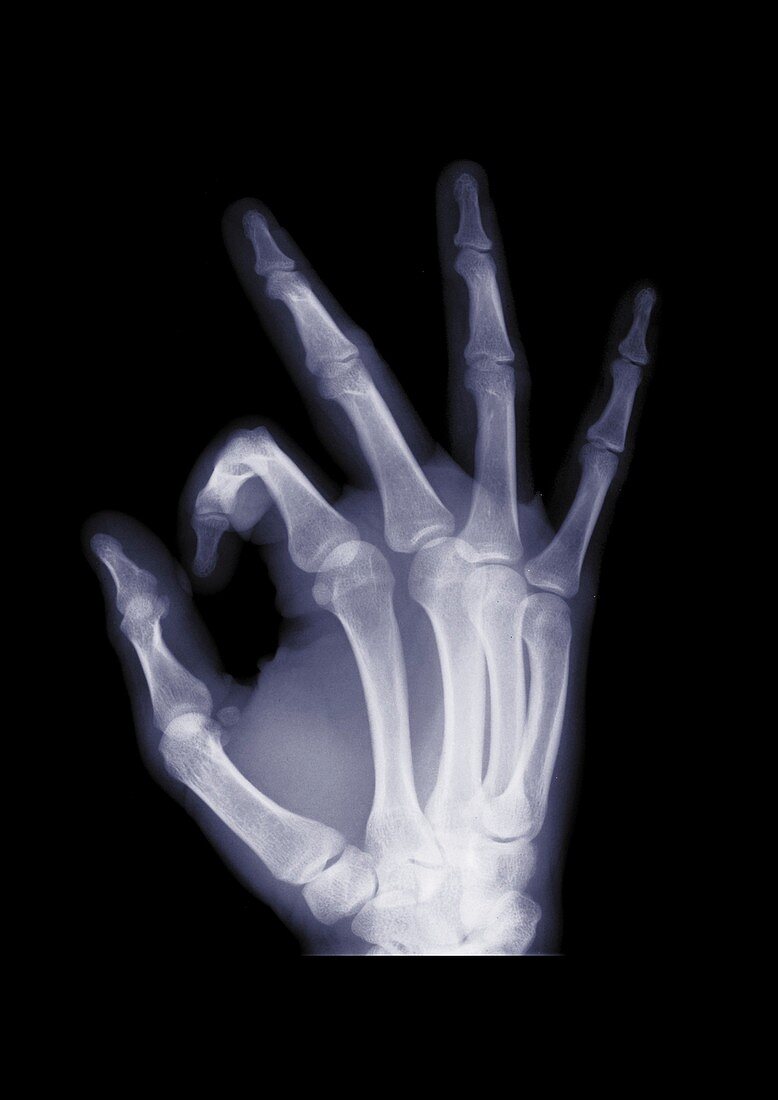 Hand making an OK gesture, X-ray
