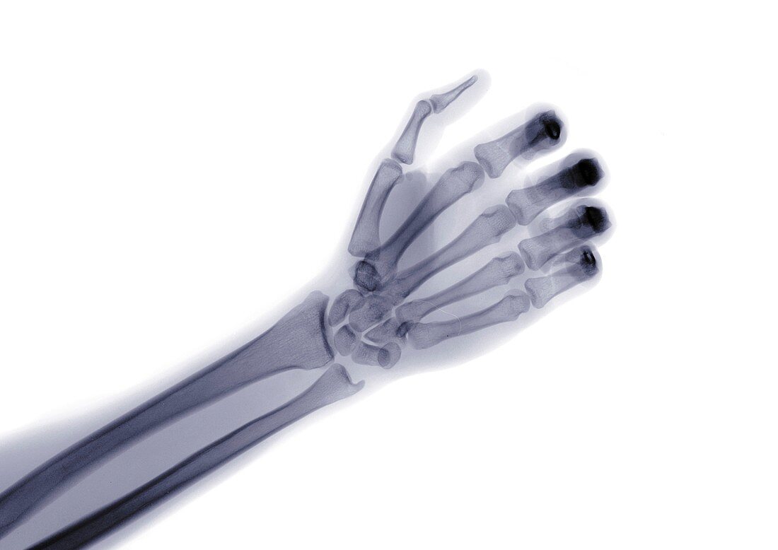 Hand and arm, X-ray