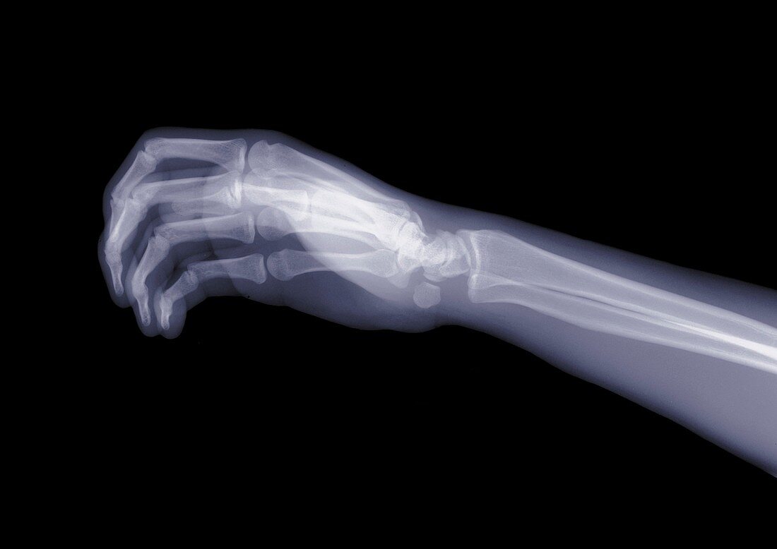 Hand and arm from the side, X-ray