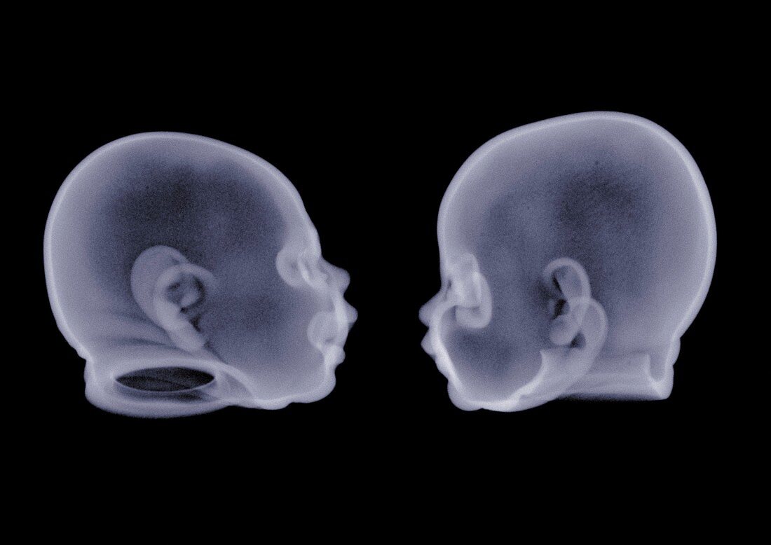 Two doll heads, X-ray