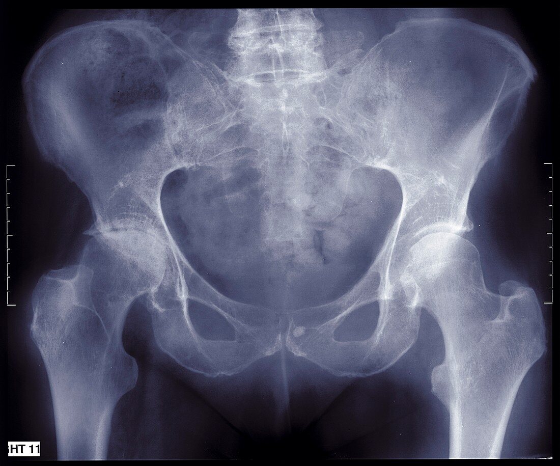 Human pelvis, X-ray