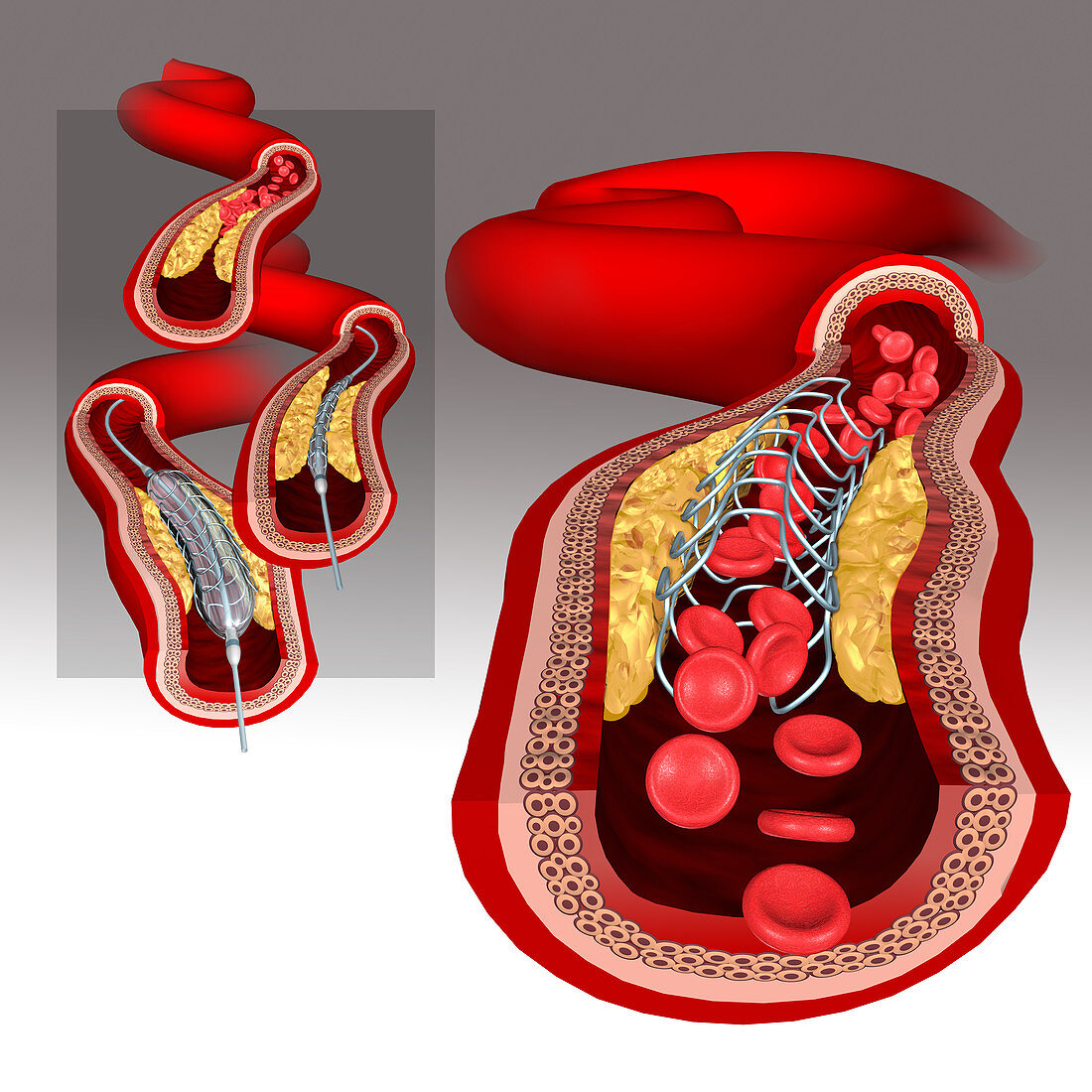 Angioplasty with stent placement, illustration