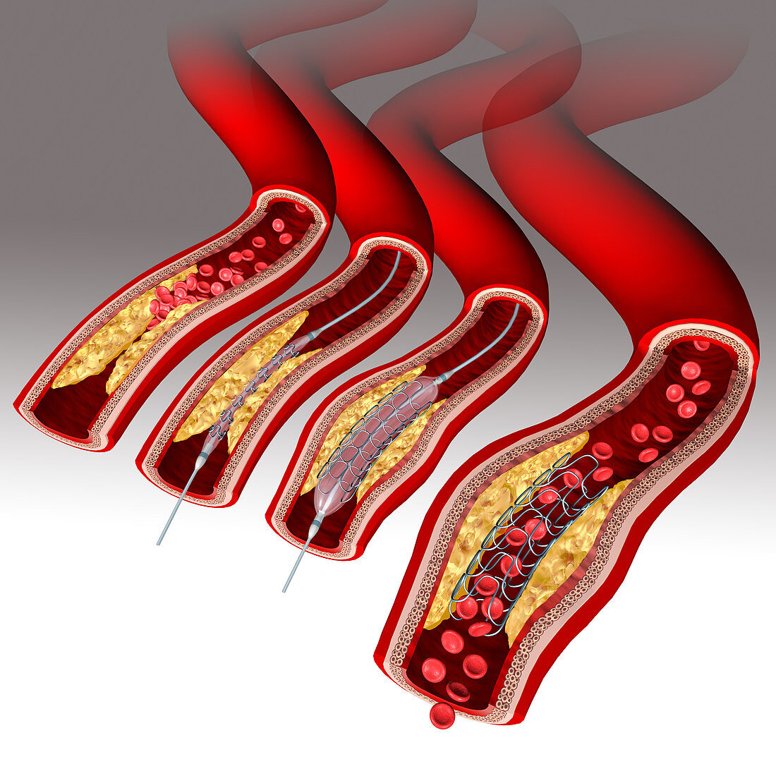Angioplasty with stent placement, illustration
