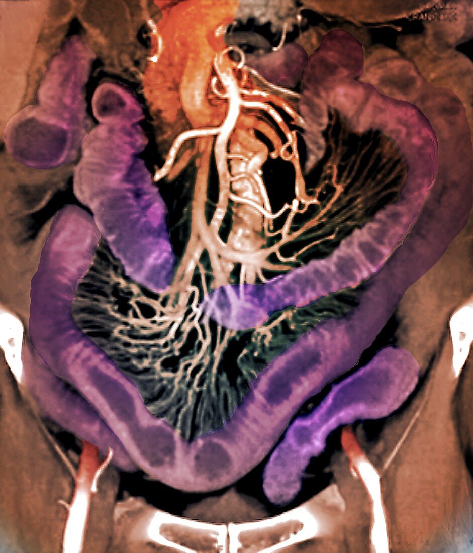 Abdominal anatomy, CT scan