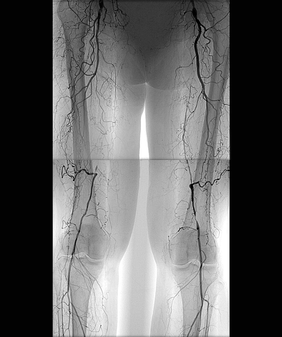 Blocked leg arteries, angiogram